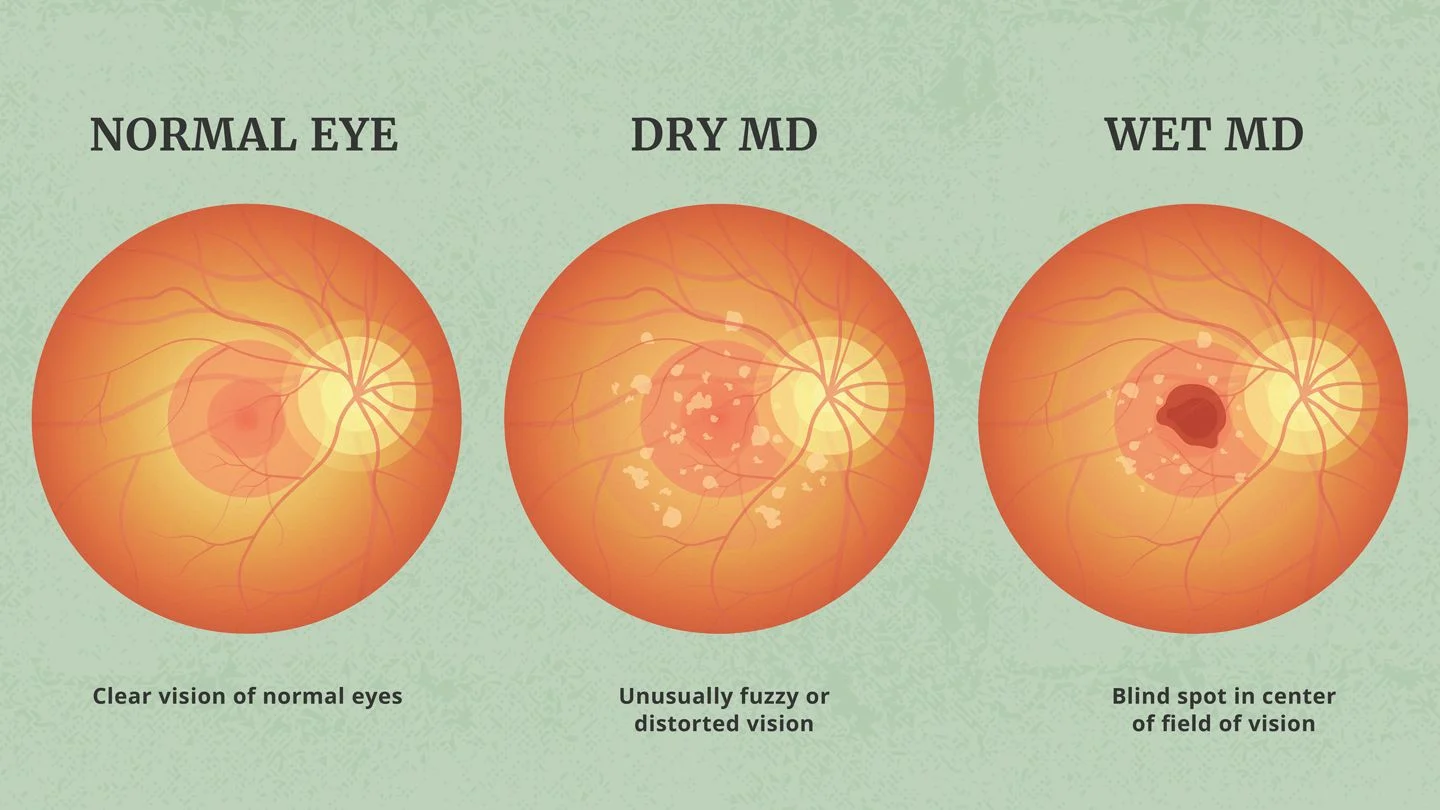 What is macular degeneration?