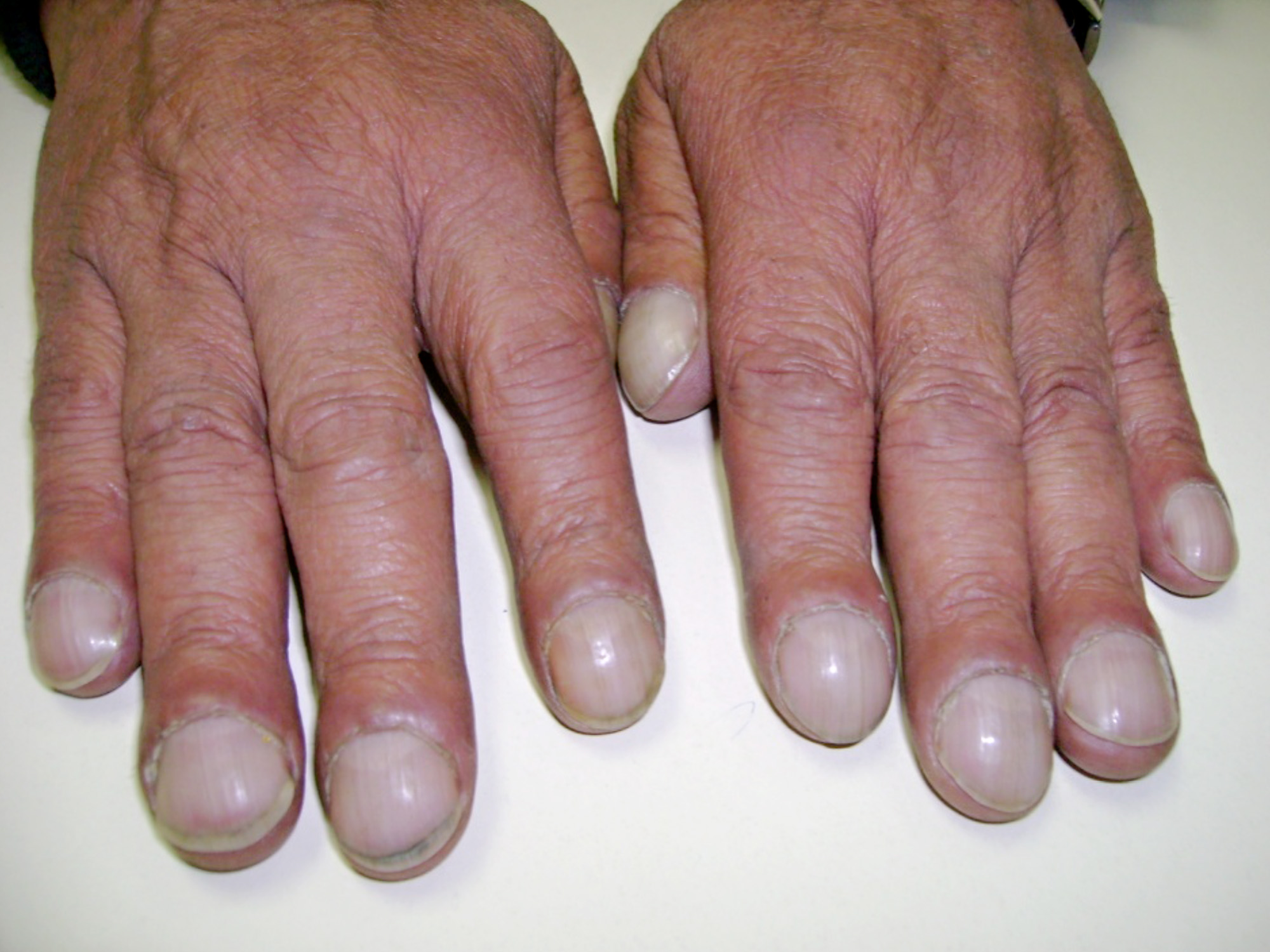 Clubbing of Fingers