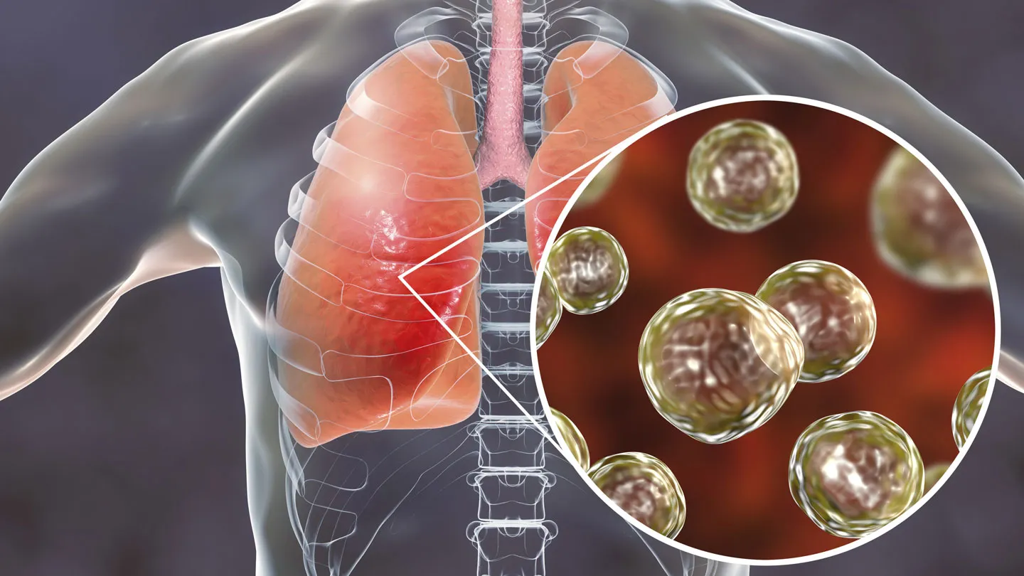 Frequent Infections