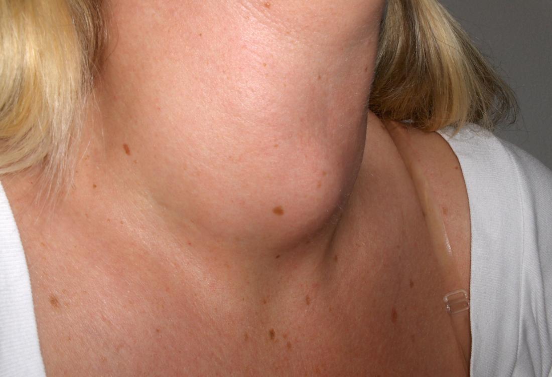 Swelling in the Face or Neck